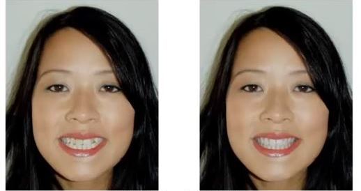 Smile Makeover by Jambert Dental
